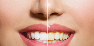 Śnieżna biel zębów- którą metodę wybrać?